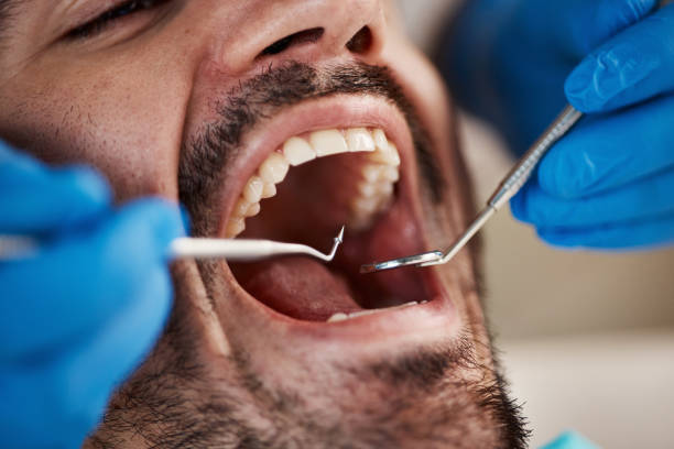 Best Emergency Broken Tooth Repair in Kingston, WA