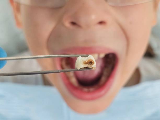 Best Emergency Tooth Extraction in Kingston, WA